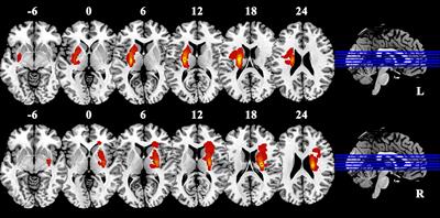 A comparative study of interhemispheric functional connectivity in patients with basal ganglia ischemic stroke